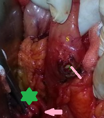 CHOLECYSTODUODENAL FISTULA