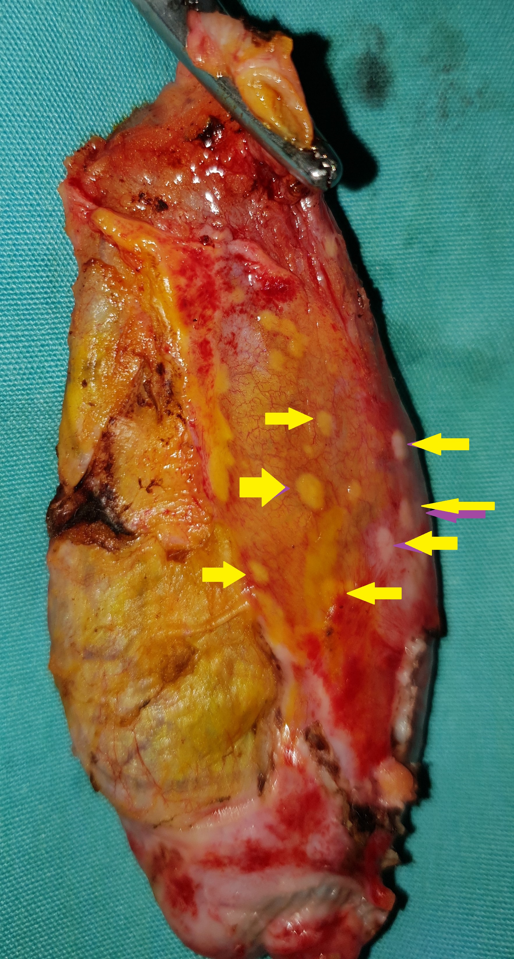 GALLBLADDER METASTASES