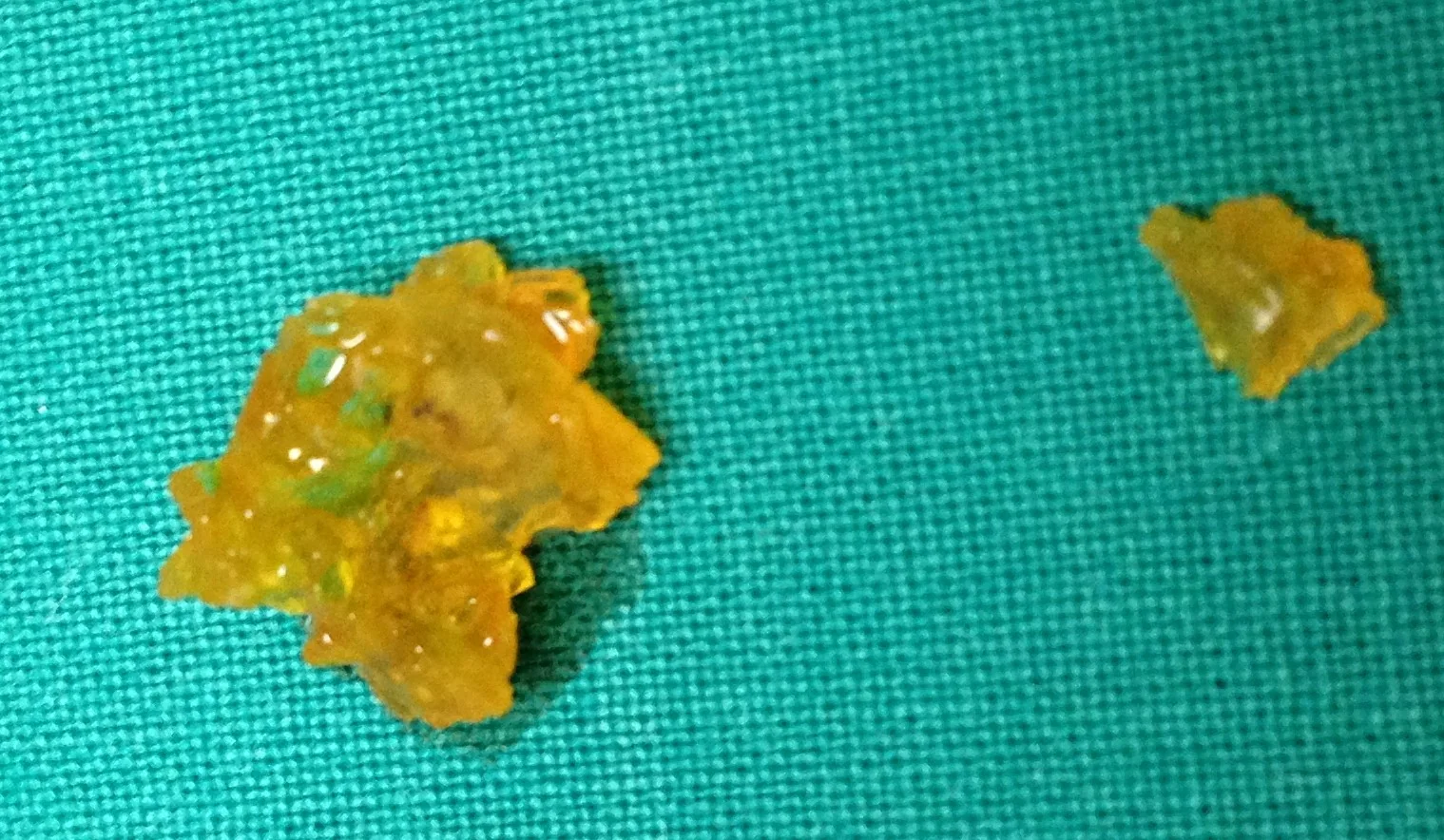 CHOLESTEROL GALLSTONES