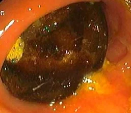 COLONIC GALLSTONES