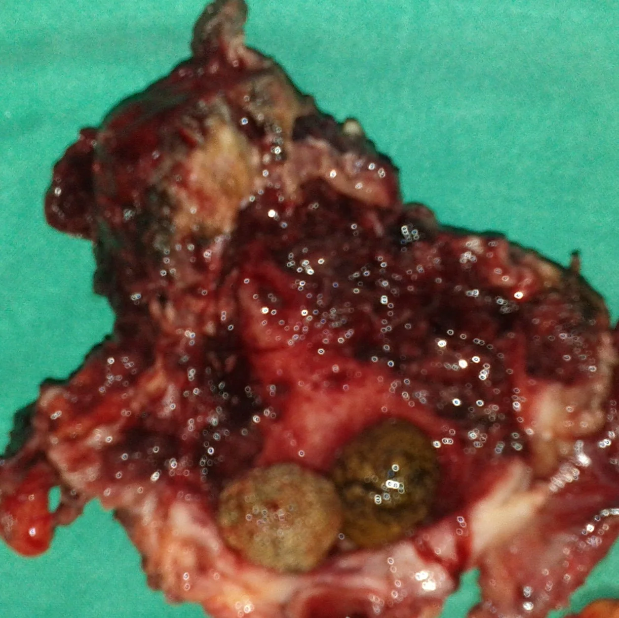 SUBTOTAL CHOLECYSTECTOMY