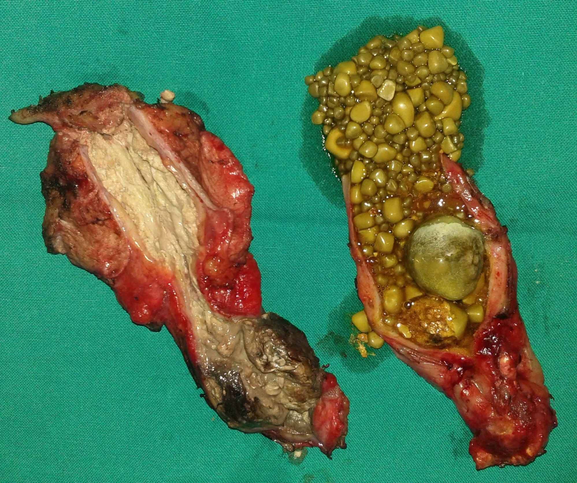 GALLSTONES - ROUND LIGAMENT INFILTRATION