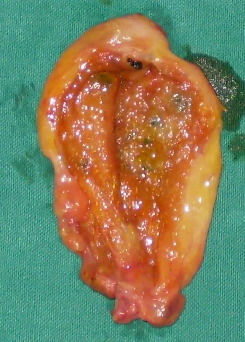 GALLBLADDER DIVERTICULA