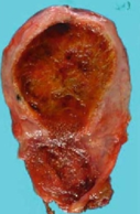 GALLBLADDER ADENOMYOMATOSIS