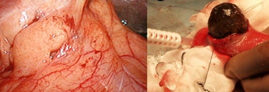 CHOLECYSTODUODENAL FISTULA