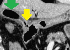 CHOLECYSTODUODENAL FISTULA