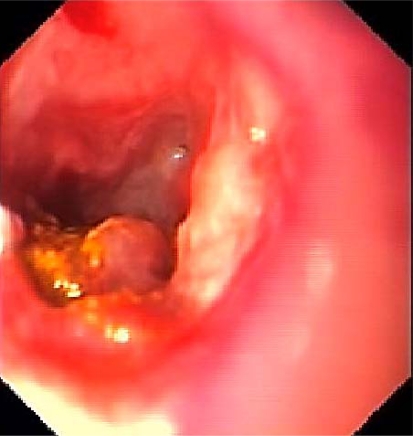 CHOLECYSTODUODENAL FISTULA