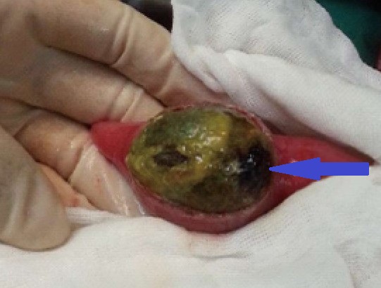 DUODENOTOMY