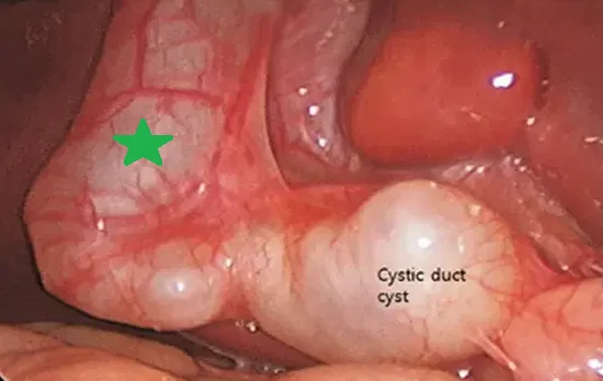 CYSTIC DUCT CYST