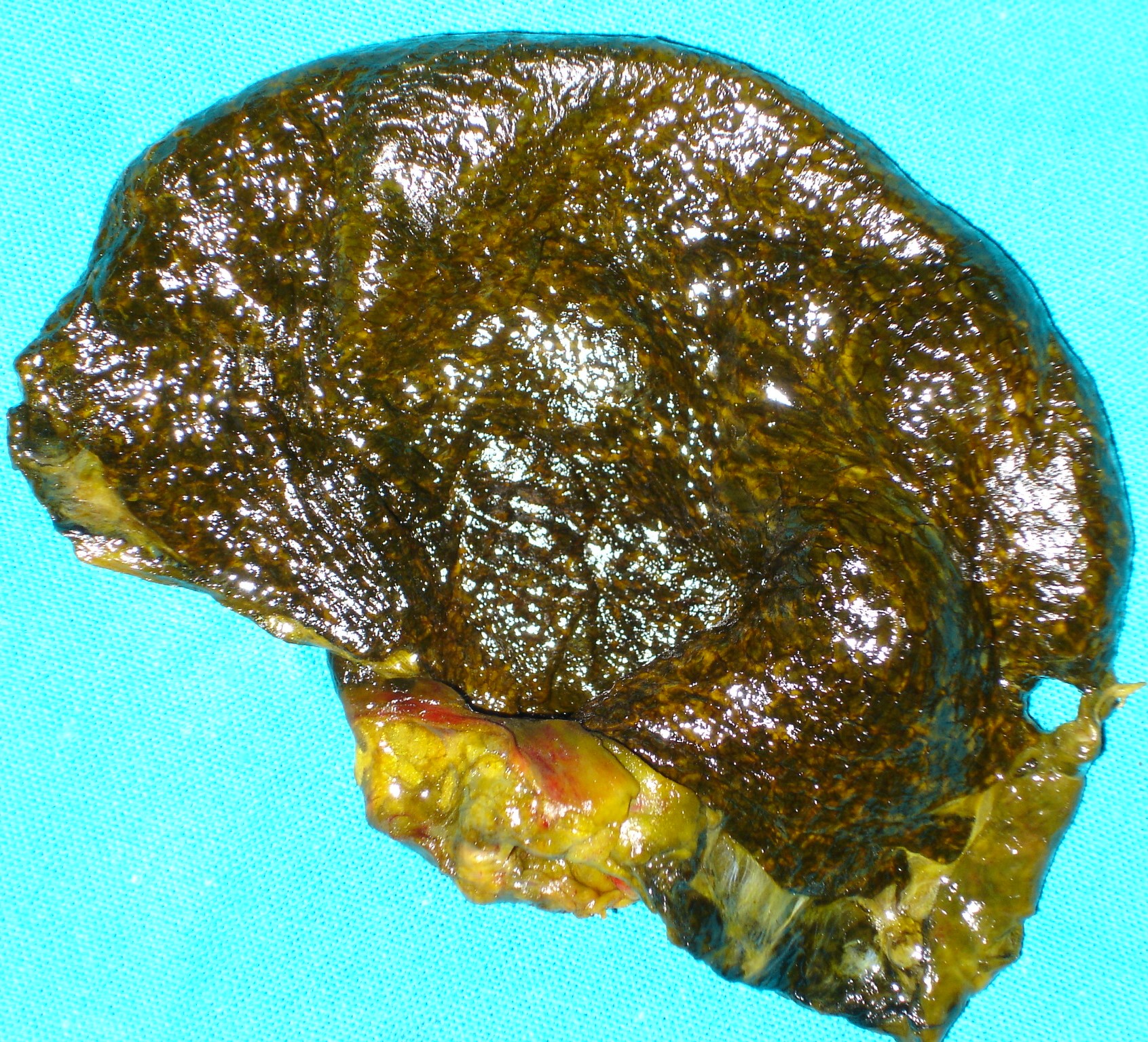 GANGRENOUS GALLBLADDER