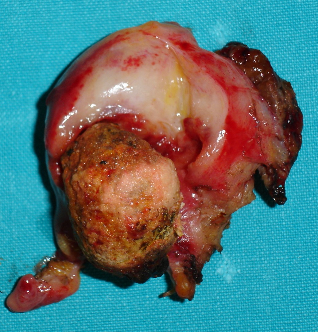 EXTREMELY THICKENED GALLBLADDER WALL