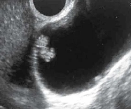 GALLBLADDER CHOLESTEROL POLYP