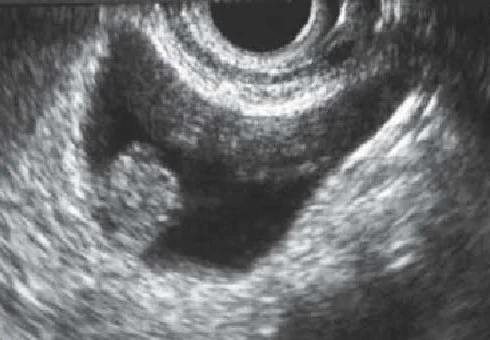 GALLBLADDER ADENOMA