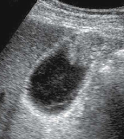 GALLBLADDER CARCINOMA