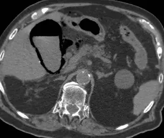 EMPHYSEMATOUS CHOLECYSTITIS