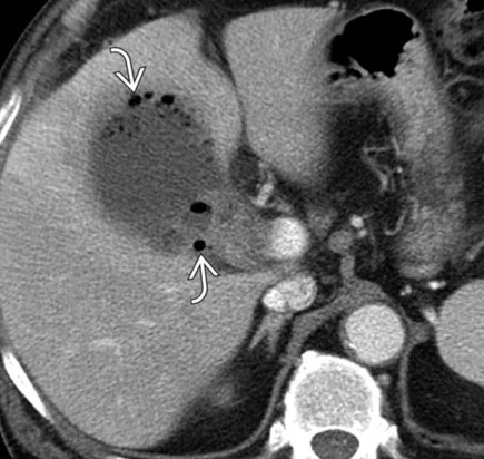 EMPHYSEMATOUS CHOLECYSTITIS