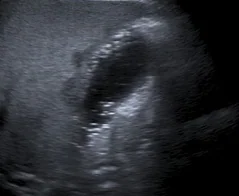 EMPHYSEMATOUS CHOLECYSTITIS