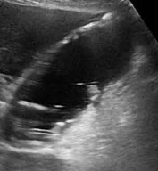 EMPHYSEMATOUS CHOLECYSTITIS