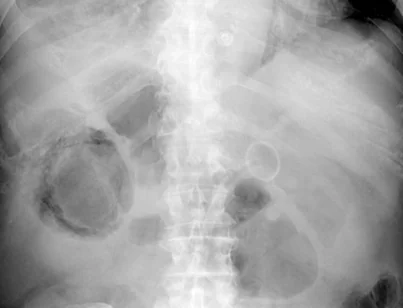 EMPHYSEMATOUS CHOLECYSTITIS