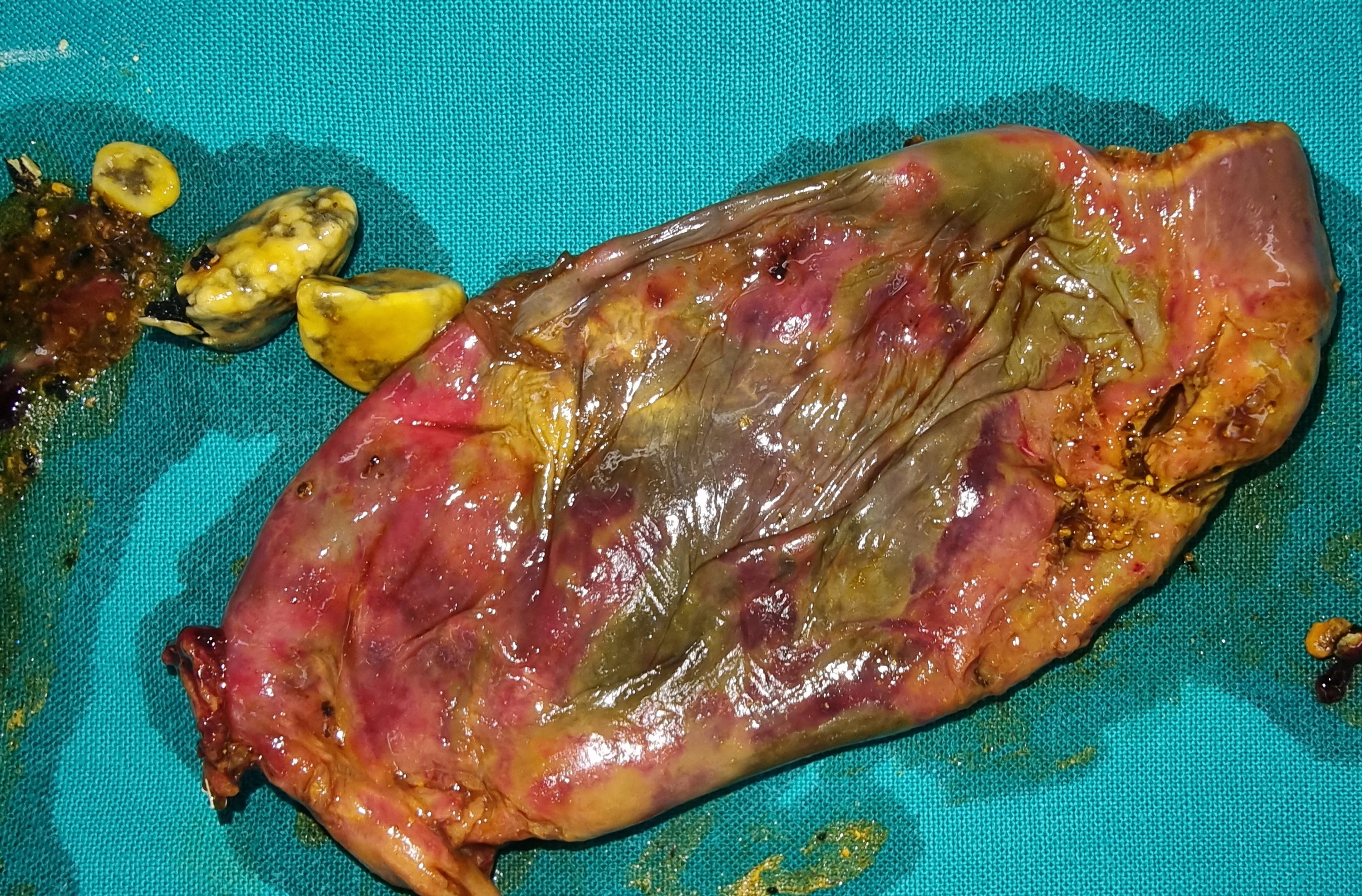 GANGRENOUS CHOLECYSTITIS