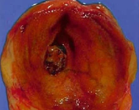 GALLBLADDER ADENOMA