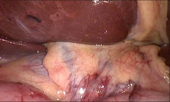 GALLBLADDER AGENESIS