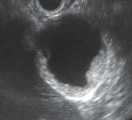 GALLBLADDER CARCINOMA