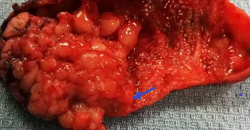GALLBLADDER CARCINOMA