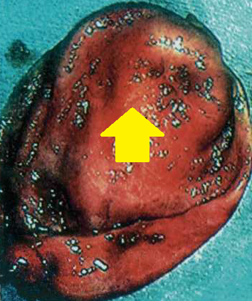 GALLBLADDER CARCINOMA