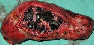 GALLBLADDER CARCINOMA