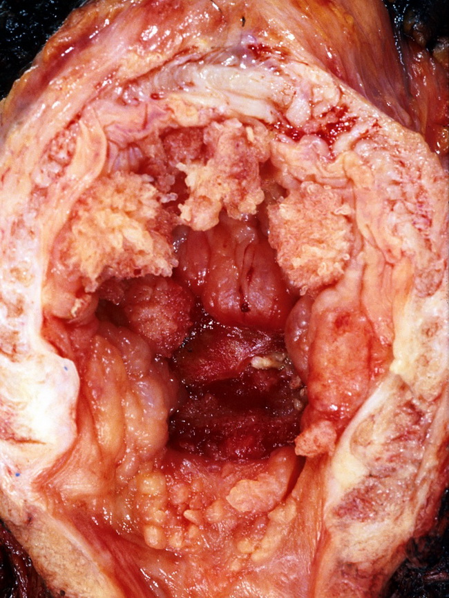GALLBLADDER CARCINOMA