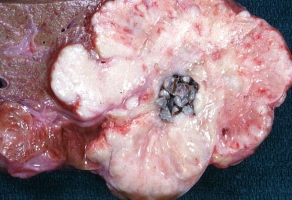 GALLBLADDER CARCINOMA