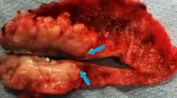 GALLBLADDER CARCINOMA 