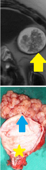 GALLBLADDER CARCINOMA