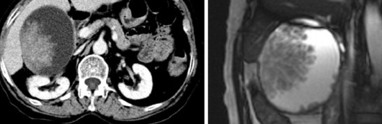 GALLBLADDER CARCINOMA