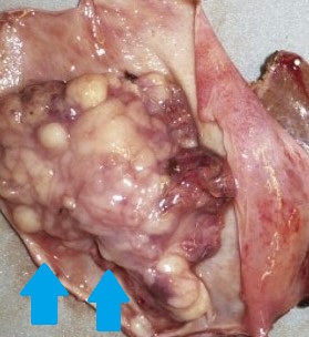 GALLBLADDER CARCINOMA