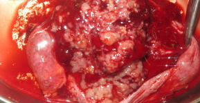 GALLBLADDER CARCINOMA 
