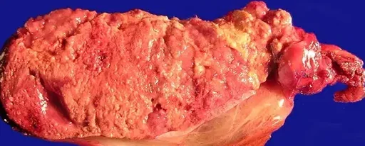 GALLBLADDER CARCINOMA 