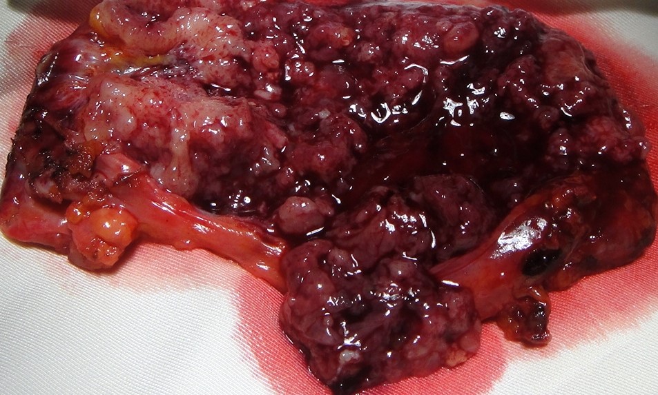 GALLBLADDER CARCINOMA