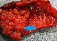 GALLBLADDER CARCINOMA