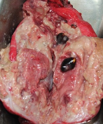 GALLBLADDER CARCINOMA