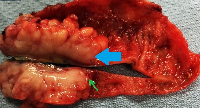 GALLBLADDER CARCINOMA