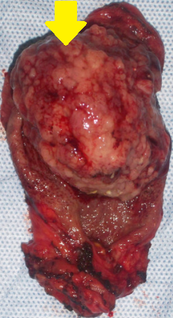 GALLBLADDER CARCINOMA