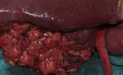 GALLBLADDER CARCINOMA