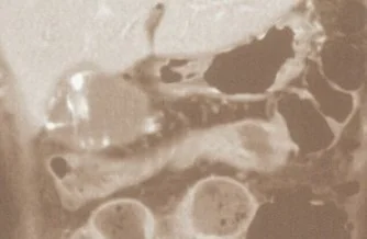 GALLBLADDER CROHN'S DISEASE