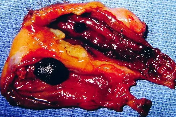 GALLBLADDER DUPLICATION