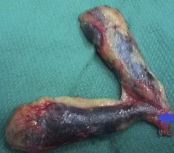 GALLBLADDER DUPLICATION