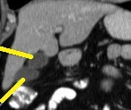 GALLBLADDER DUPLICATION
