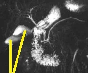 GALLBLADDER DUPLICATION