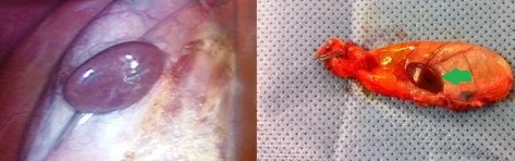 GALLBLADDER ECTOPIC LIVER